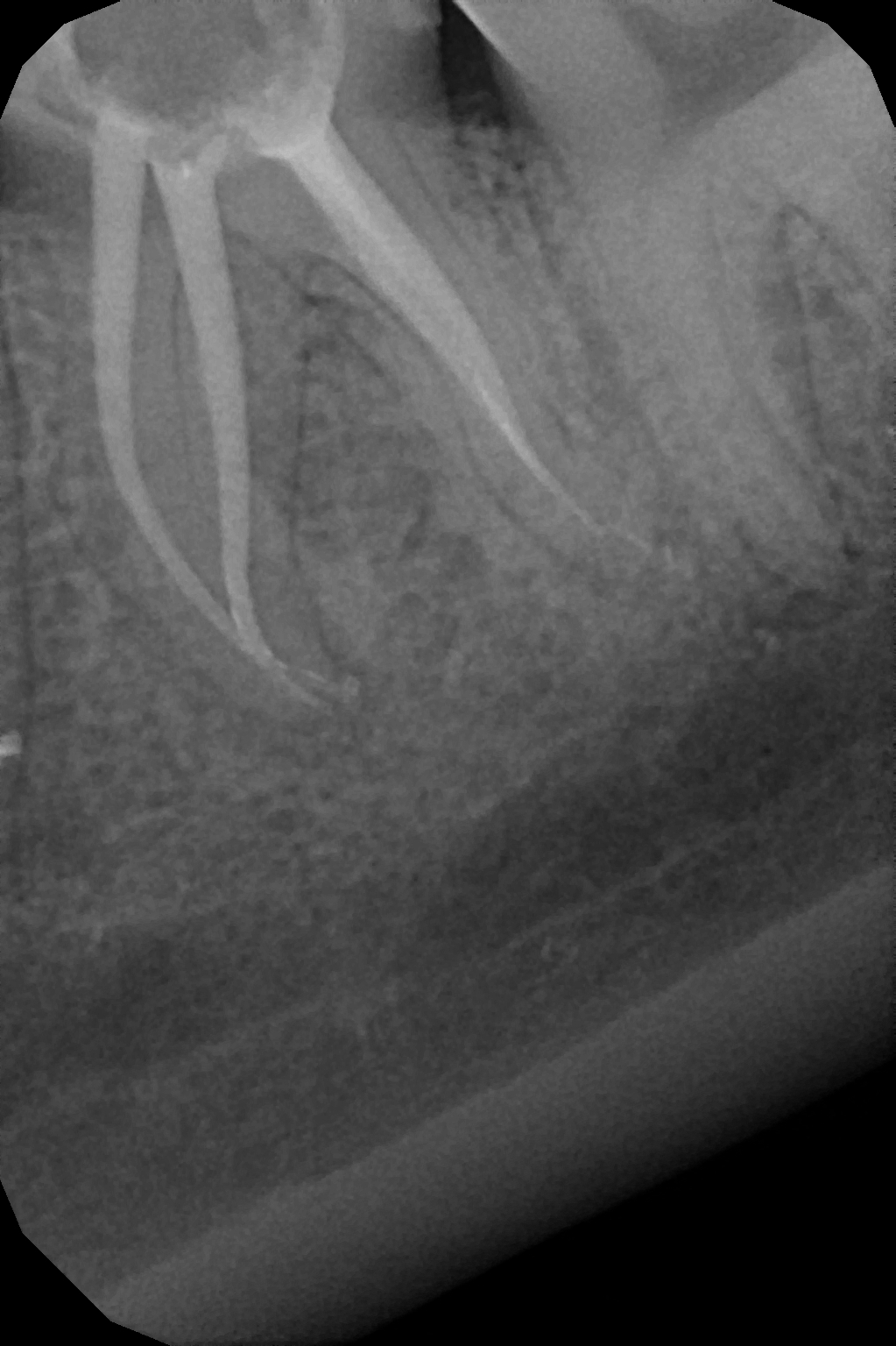 endodoncja mikroskopowa 10.jpg