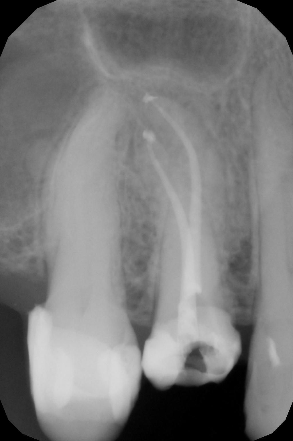 endodoncja mikroskopowa 11.jpg