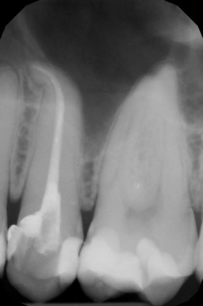 endodoncja mikroskopowa 12