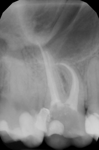 endodoncja mikroskopowa 14