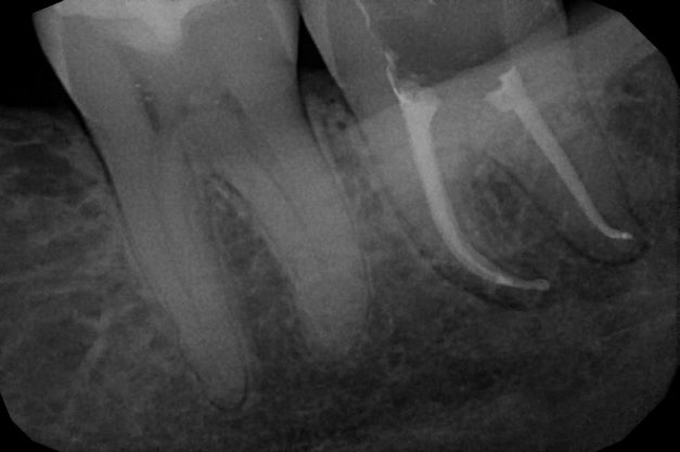 endodoncja mikroskopowa 15