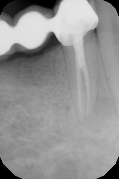 endodoncja mikroskopowa 16