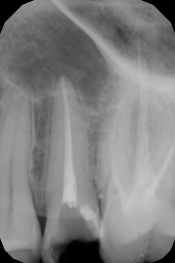 endodoncja mikroskopowa 2