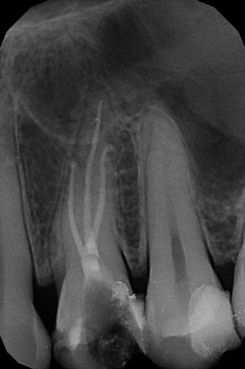 endodoncja mikroskopowa 3