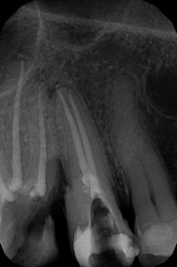 endodoncja mikroskopowa 4