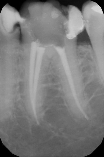 endodoncja mikroskopowa 5