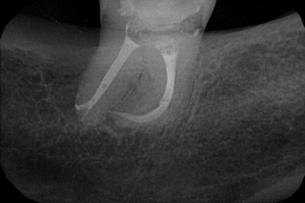 endodoncja mikroskopowa 7