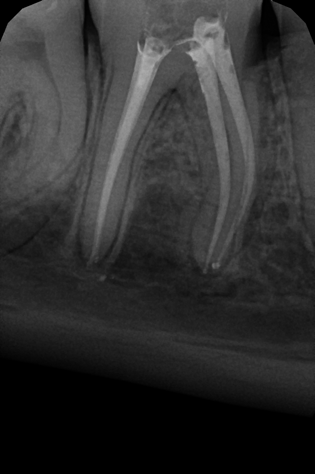endodoncja mikroskopowa 8.jpg