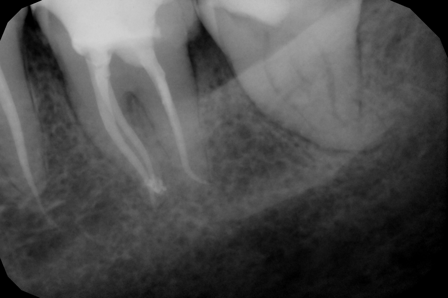 endodoncja mikroskopowa 9.jpg